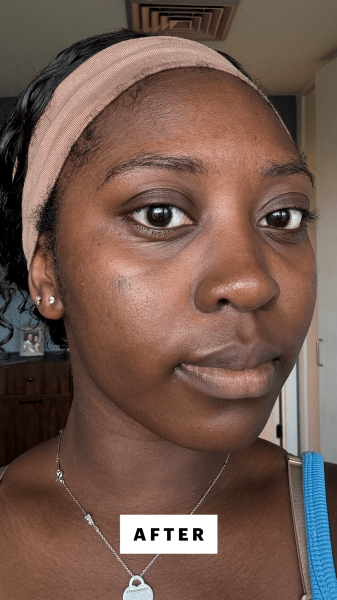 BlayTettey after applying the Celimax Jiwoogae Heartleaf BHA Peeling  Exfoliating Pads